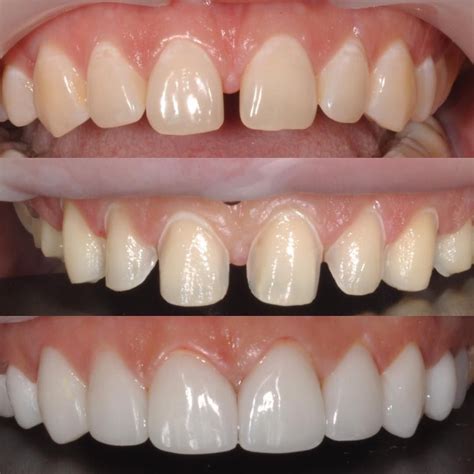 Veneers Teeth Dental Veneers Teeth Implants Dental Implants Dental Art Dental Clinic Lente