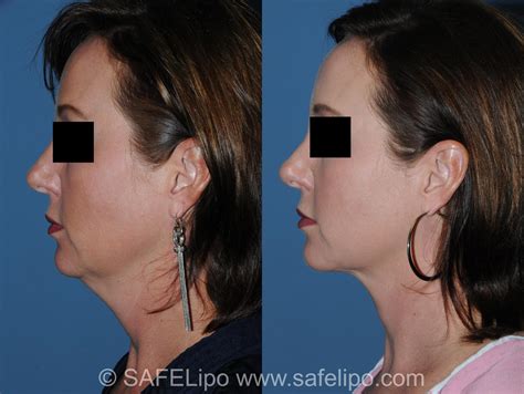 Double Chin Reduction Before And After Pictures Case 349 Safelipo®