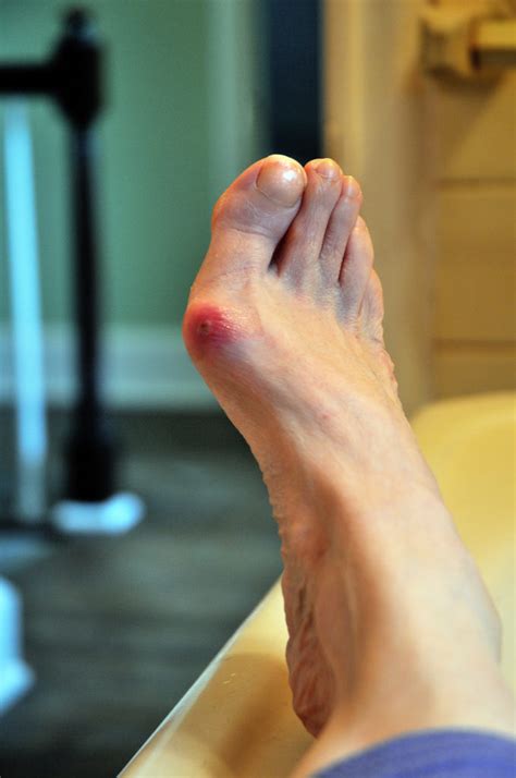 What Happens If You Let A Bunion Go Untreated Dr Schoene