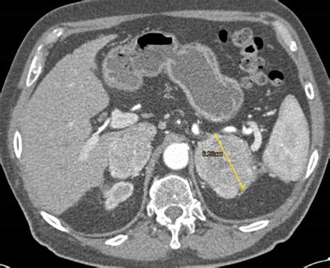 Bilateral Adrenal Metastases Due To Renal Cell Carcinoma Adrenal Case