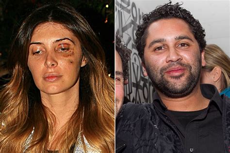 Brittny Gastineau Steps Out With Black Eye After ‘mutual’ Attack Page Six