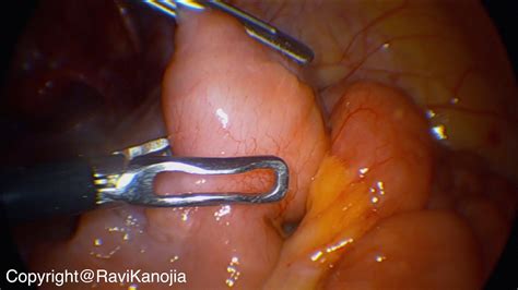 Laparoscopic Retrieval Of Endoscopy Capsule Youtube