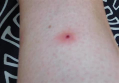 Infected Bed Bug Bite Symptoms Pest Phobia