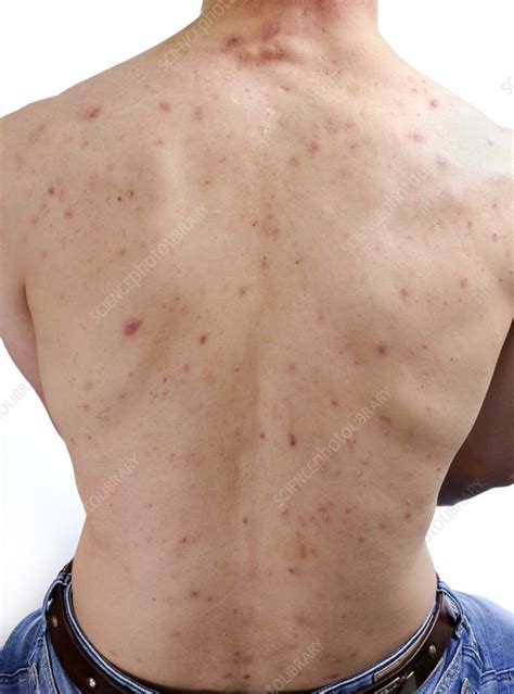 Acne Vulgaris On The Back Stock Image C0115491 Science Photo Library
