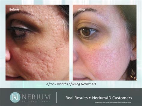 A dermatologist will inject the pock mark with a substance like fat or collagen to fill it in and make it even with the rest of your face. Acne scars and pock marks are hard to get rid of...until ...