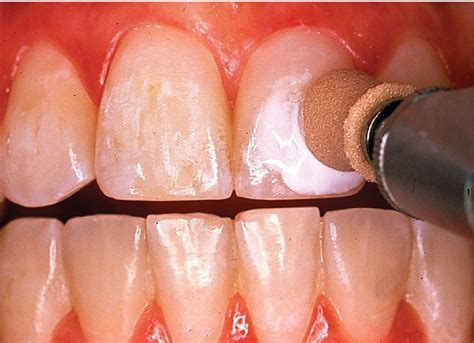 Debonding Orthodontic Resins Pocket Dentistry