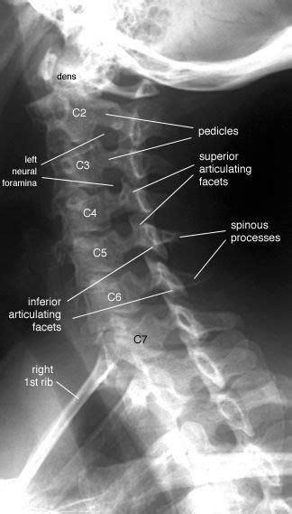 Radiographic Anatomy Of The Skeleton Cervical Spine Left Anterior