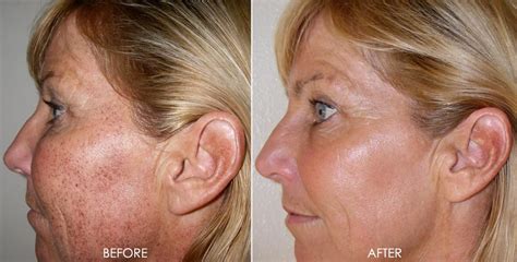 Ipl Before After Dr Monica Scheel Dermatology