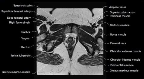 The tensor fascia lata and sartorious muscles originate from the anterior superior iliac spine. mri female pelvis anatomy axial image 26 | Pelvis anatomy ...