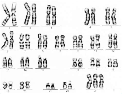 File Chromosome Trisomy Embryology My Xxx Hot Girl