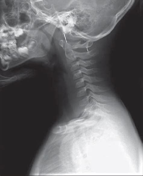 Normal Measurements Of Occipital Cervical Junction In 6 Year Old Boy