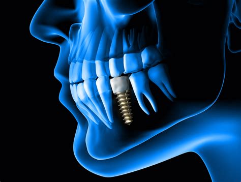 Implantes Dentales Todas Sus Ventajas E Inconvenientes Estudi Dental