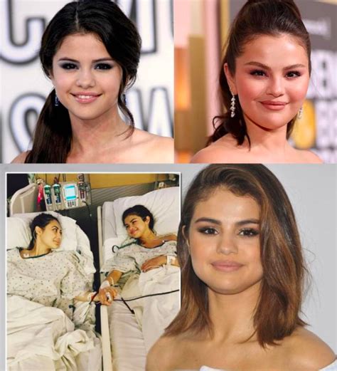Apa Itu Penyakit Lupus Yang Dialami Oleh Selena Gomez