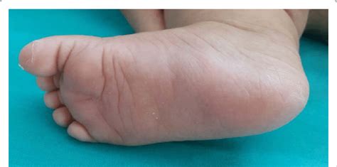 Erythema Swelling Of The Feet And Peeling At The Toes Download