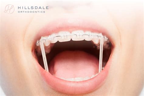 How Do Rubber Bands Work For Orthodontic Braces Hillsdale Orthodontics