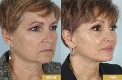 Facial Plastic Surgery In The Woodlands Tx Dr Guy Facial Plastic