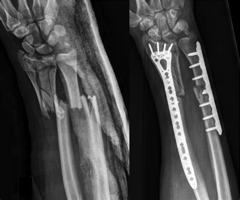 Extra Articular Distal Radius Fractures With Metaphyseal Comminution