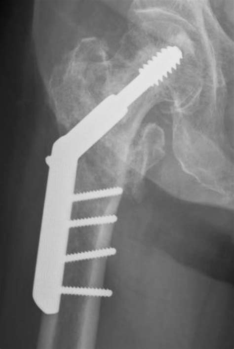 Diffuse Cement Distribution Pattern In Cement Augmented Dynamic Hip