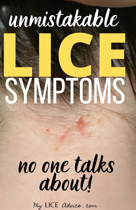 17 Lice Symptoms With Pictures Signs That You Have Head Lice Head