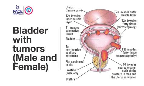 Transurethral Resection Of The Bladder