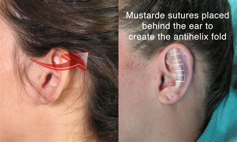 Mustarde Antihelix Otoplasty Cosmetic Ear Reshaping Surgery