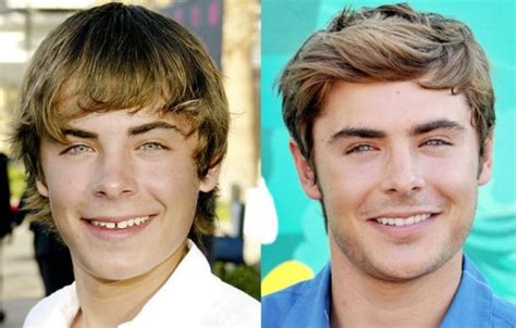zac efron before and after plastic surgery 19 celebrity plastic surgery online