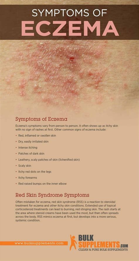 Eczema Characteristics Causes And Treatment