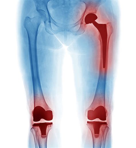 How Long Do Joint Replacements Last Health News Hub