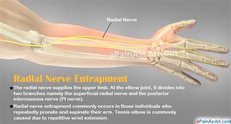 Pdf Radial Nerve Entrapment Caused By A Ganglion Cyst At The Elbow My