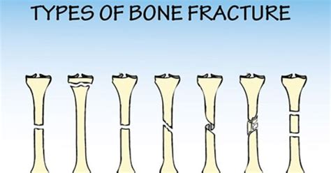 Types Of Bone Fractures Pdf
