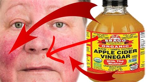 How To Use Apple Cider Vinegar For Face Skin Issues Face Toner Wash