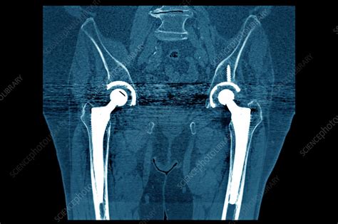 Hip Prosthesis Ct Scan Stock Image C0269515 Science Photo Library