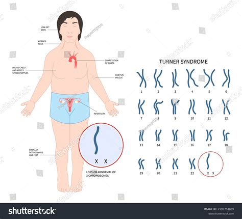 Klinefelters Syndrome Images Stock Photos Vectors Shutterstock