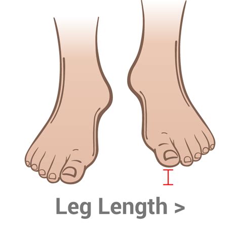 Leg Length Discrepancy Barefoot Freedom