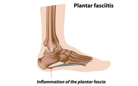 Treatment Of Plantar Fasciitis With Orthotics Orthopaedic Product News