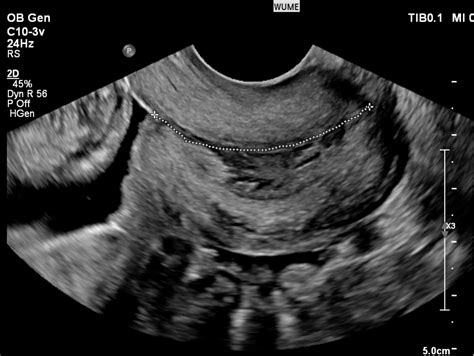 Ultrasound In Pregnancy Womens Ultrasound Melbourne