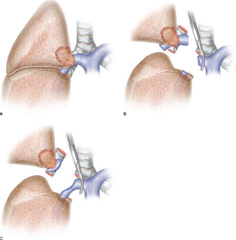 Pulmonary Artery Sleeve Resection And Lobectomy Master Techniques In