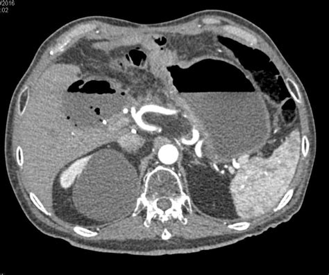 Abscess In Gall Bladder Fossa Liver Case Studies Ctisus Ct Scanning