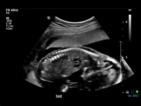 Fetal Presentation Bcpocus
