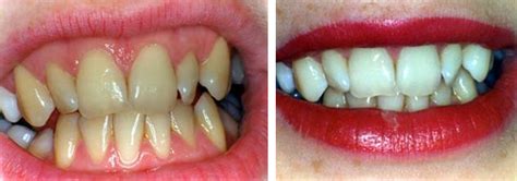 Rinse the area and pat dry. Tooth Whitening BPDS Chepstow Dental - Cosmetic Family ...
