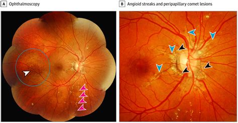 Angioid Streaks And Other Retinopathy In Pseudoxanthoma Elasticum