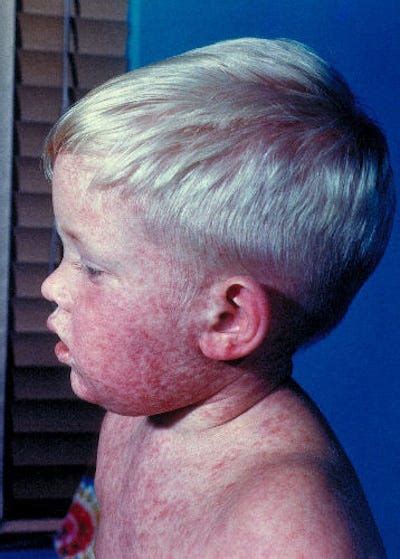 What The Measles Really Looks Like Business Insider