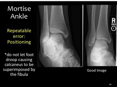 Mortise Ankle Medical Radiography Diagnostic Imaging Radiology Imaging