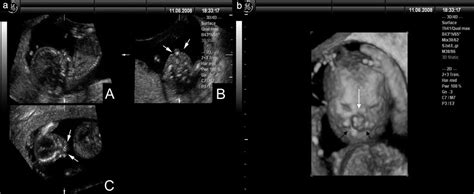 Three‐dimensional Sonographic Imaging Of Fetal Bilateral Cleft Lip And