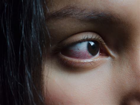 What Exactly Causes Red Eyes That Look All Bloodshot Self