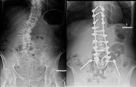 Degenerative Scoliosis Of The Lumbar Spine Spine Specialist