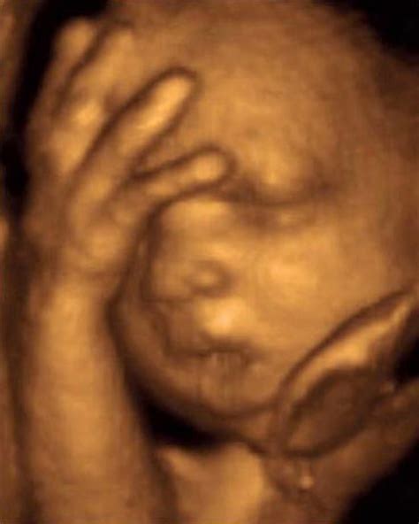 29 Weeks Fetus Ultrasound