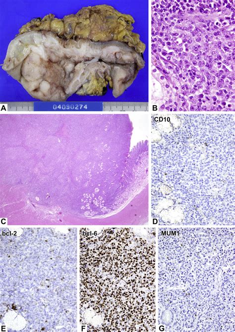 A Representative Case Of Primary Gastric Lymphoma A And C Gross