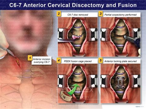 C6 7 Anterior Cervical Discectomy And Fusion Trial Exhibits Inc