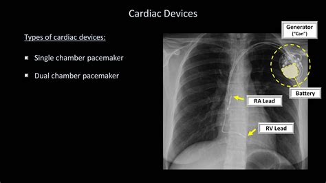 How To Interpret A Chest X Ray Lesson 9 Atelectasis Lines Tubes